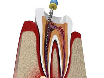Root Canal Treatment, Cost , Dentist Specialist in Hyderabad - Aparna Dental Clinic