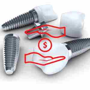 Affordable dental implants-Attapur-Hyderabad dental clinic & implant centre
