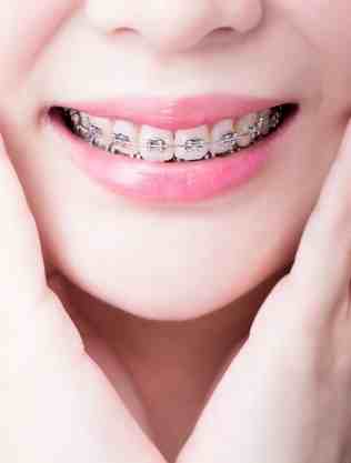 Dental braces-Teeth braces-Hyderabad dental clinic & implant centre