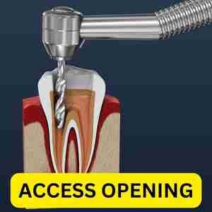 ACCESS OPENING -ROOT CANAL THERAPY | Teeth Infection