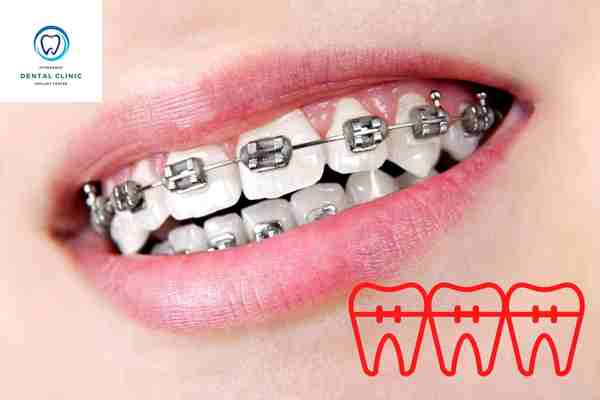 est dental braces in Hyderabad