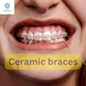 Ceramic braces