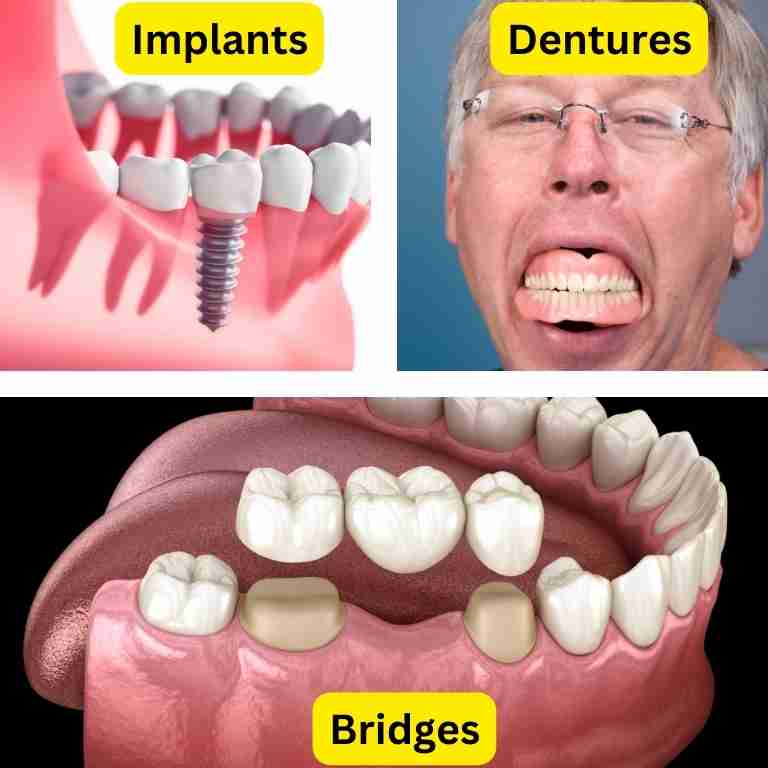 Implants, dentures and bridges comparison