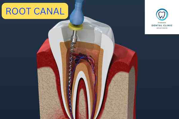ROOT CANAL TREATMENT FOR TEETH INFECTION | HYDERABAD DENTAL CLINIC-ATTAPUR