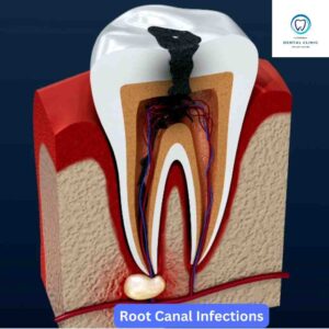 Root Canal Infection | root canal treatment in Hyderabad