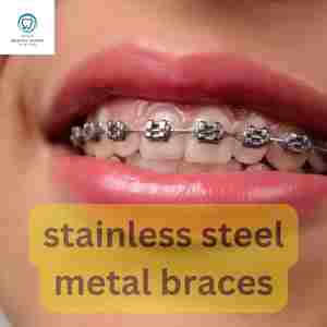 Stainless steel metal braces