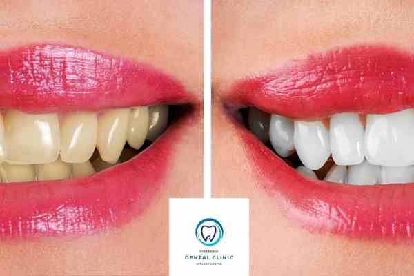 How to Get the Perfect Smile on a Budget-Tooth Whitening in Hyderabad