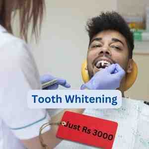 Tooth Whitening cost in Hyderabad