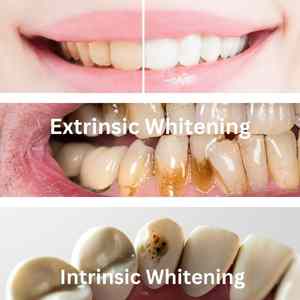 ooth Whitening types
